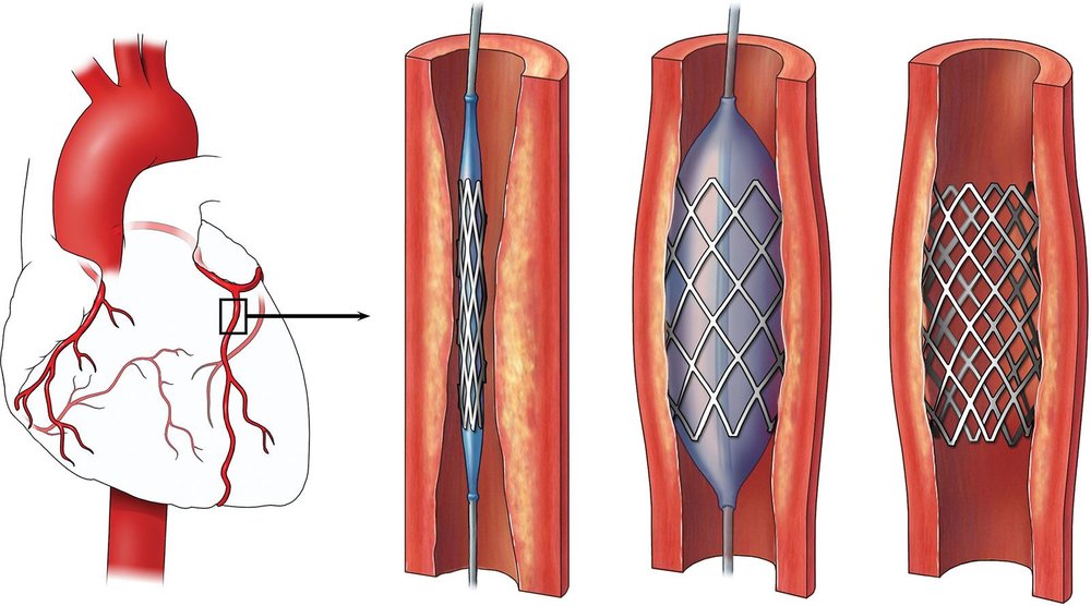 angioplasty