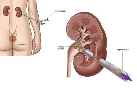 percutaneous nephrolithotomy 1