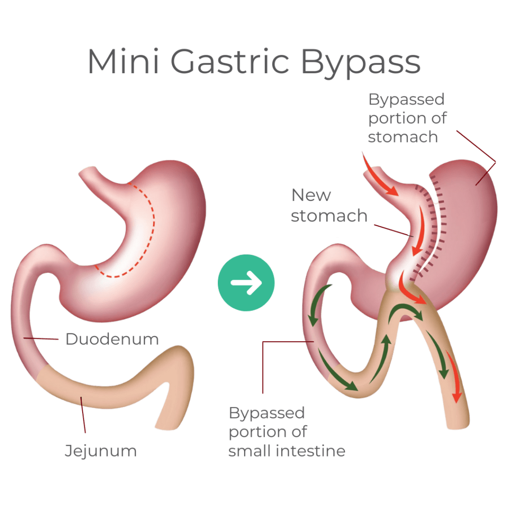 Gastric Bypass Surgery