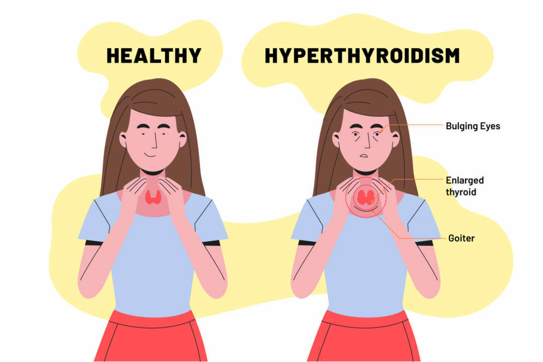 Thyroidectomy scaled